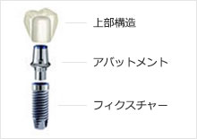 インプラントの構造