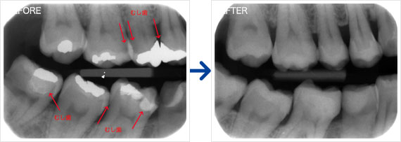 虫歯治療例
