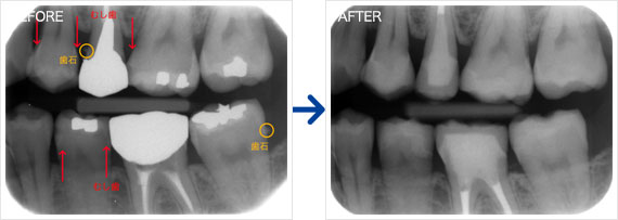 虫歯治療例