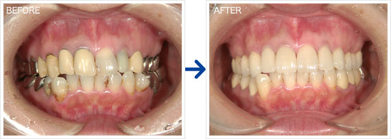 セラミック治療例