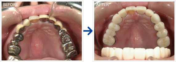 セラミック治療例