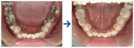 セラミック（インレー）治療例