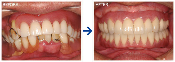 インプラント治療例
