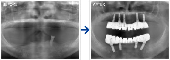インプラント治療例