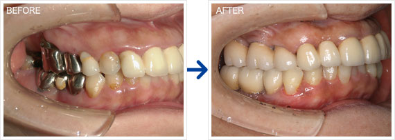 インプラント治療例