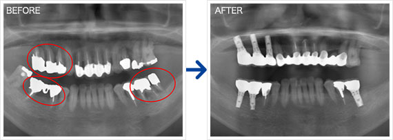 インプラント治療例