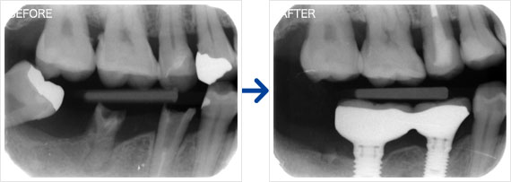 インプラント治療例